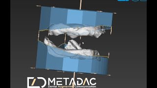 Digital Dentures Edentulous models [upl. by Lairret440]