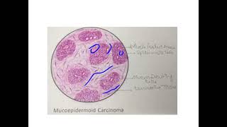 Mucoepidermoid carcinoma [upl. by Anujra227]