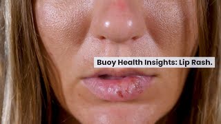 Lip Rash Common Causes and When to Seek Medical Care  BuoyHealthcom [upl. by Garald]