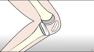 Knee Replacement vs Regenexx Orthopedic Regenerative Treatment [upl. by Esiuol]