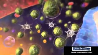 Acute Lymphocytic Leukemia ALL Animation [upl. by Rafaela]