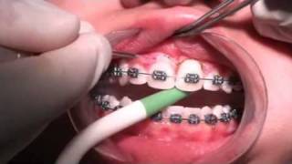 Gengivoplastia com Laser [upl. by Adnarahs328]