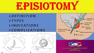 Episiotomy Definition Indications Types Complications [upl. by Schonthal882]