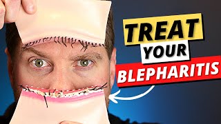 Blepharitis Top 3 Treatments For Blepharitis Removal At Home [upl. by Aribold498]