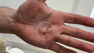 Dr E Levits treatment of Dupuytrens Contracture [upl. by Weidman131]