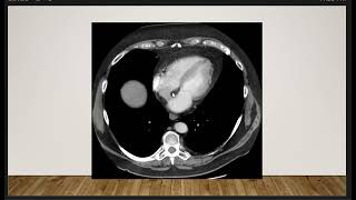 Short Case Discussion  Lipomatous Hypertrophy of the interatrial septum [upl. by Lorimer471]