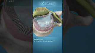 What is Endoscopic Anterior Cervical Discectomy shorts [upl. by Irrem]