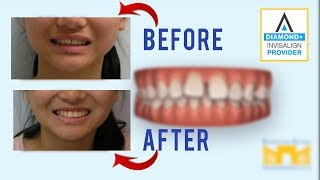 Invisalign Before and After Gap in Teeth [upl. by Falcone]