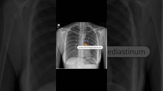 Pneumomediastinum and subcutaneous emphysema [upl. by Anaerol]