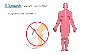 GuillainBarre Syndrome GBS Described Concisely [upl. by Mercer]