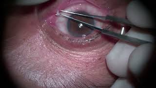 Punctal Stenosis Monocanalicular Stent Insertion Save the Punctum [upl. by Eilyab633]