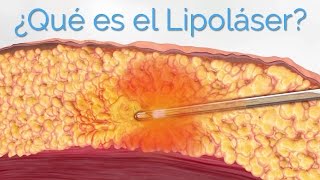 Liposucción Láser ¿Qué es el Lipoláser y Para Qué Sirve [upl. by Rdnaskela225]