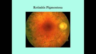 Retinitis Pigmentosa  CRASH Medical Review Series [upl. by Deibel7]