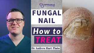 How to TREAT Fungal Nail  Get Rid Of Nail Fungus AntiFungal Lacquer amp Tablets [upl. by Aianat]