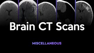 Brain CT Scans A Wide Variety Conditions [upl. by Elleron276]