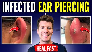 Doctor explains HOW TO RECOGNIZE AND TREAT INFECTED EAR PIERCING [upl. by Oran460]