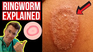 Doctor explains Ringworm aka Tinea including symptoms signs causes and treatment [upl. by Reich]