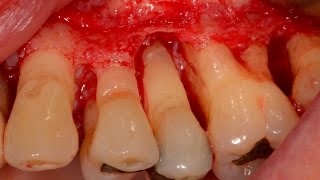 Treat Periodontal Gum Disease before placing Dental Implant [upl. by Scholz]