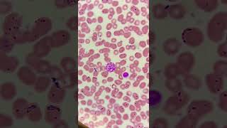 Malaria parasite under microscopePlasmodium vivax trophozoite ring and gametocytesmicroscopy [upl. by Folly]