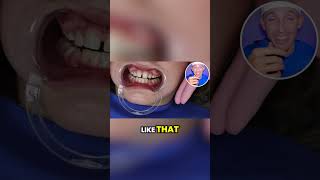 The Process of Getting Braces [upl. by Lodi]