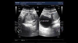 Ultrasound Video showing Large Lt Ovarian Cyst and Endometrial hyperplasia [upl. by Oal106]