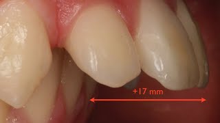 Tratamiento Ortodóncico de dientes adelantados sin extracciones Clase II esquelética [upl. by Baugh]