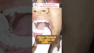 Clear AlignersAligners before and afterAligners cost in IndiaInvisalignytshortsshorts trending [upl. by Aisyle517]