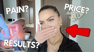 I got veneers in Dubai no teeth shaving before  after VLOG [upl. by Vivle]