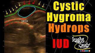 Cystic Hygroma  Hydrops Fetalis  Ultrasound  Anomaly  Case 214 [upl. by Etnovahs]