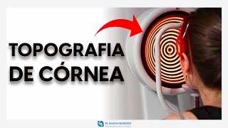 Topografia de córnea  DrGustavo Bonfadini [upl. by Searby]