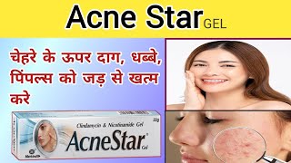 Acne star gel  Acne star gel benefits  How to remove acne amp pimple [upl. by Nashbar]