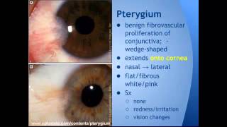 Pterygium vs Pinguecula quotEM in 5quot [upl. by Mahgem687]