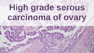 High Grade Serous Carcinoma of Ovary  Pathology mini tutorial [upl. by Gavan]