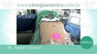 Lipo a Laser como funciona e qual a vantagem [upl. by Nagard]