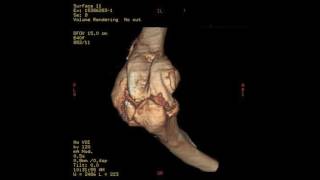 Elbow heterotopic ossification CT [upl. by Esiled]