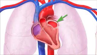 Semiologia Ausculta Cardíaca  Estenose mitral [upl. by Ahsyekat]