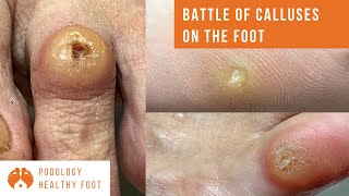 BATTLE OF CALLUSES ON THE FOOT 3 calluses removal on different parts of the foot ASMR podologia [upl. by Puklich]