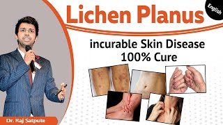 Lichen Planus Skin Disease 100 Results From The First Week [upl. by Eitsirk909]