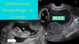 Subchorionic Hemorrhage ultrasound 12 weeks [upl. by Iggam]