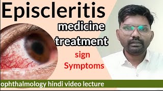 Episcleritis treatment  Episcleritis disease in eye  sclera anatomy  Episcleritis  optometry [upl. by Aerdnod]