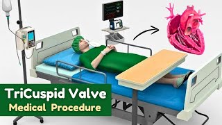 Tricuspid valve  Medical Procedure Animation [upl. by Kelwin]