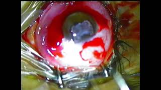 Pterygium operation of MrAmir Hossain [upl. by Nylra]