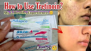 My 2 Months Experience with Tretinoin  How to Use Skin A cream  How to use Adapco cream [upl. by Eiuol]