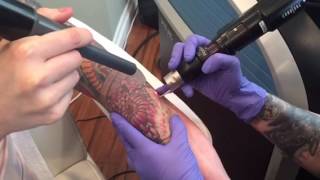 PicoSure Tattoo Removal  Color Ink on Arm [upl. by Seve]