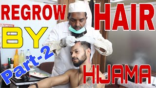 REGROW HAIR BY HIJAMA CUPPING THERAPY  PART2  HINDI  ANI RAY [upl. by Brace]