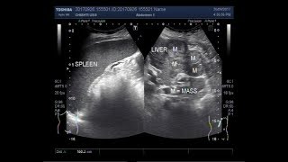 Ultrasound Video showing hepatic parenchymal disease with multiple masses and splenomegaly [upl. by Rochus479]