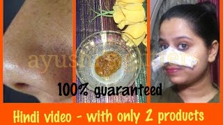 ब्लैक हेड्स हमेशा के लिए हटाने का सबसे अच्छा तरीका  BEST WAY TO REMOVE BLACKHEADS PERMANENTLY [upl. by Ellie]