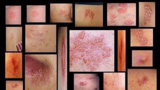 Genital Herpes Symptoms Men and Women  Home Testing  Herpes Treatment Cure Facts [upl. by Eceinwahs447]