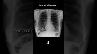 Chilaiditis phenomenon  example 23 Abnormal bowel gas pattern radiologychannel007 [upl. by Bjork]