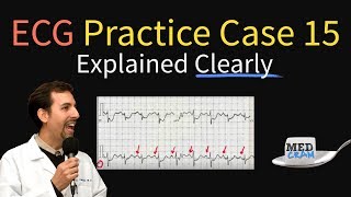 ECG  EKG Practice Case 15  Step by Step Interpretation [upl. by Eylhsa]